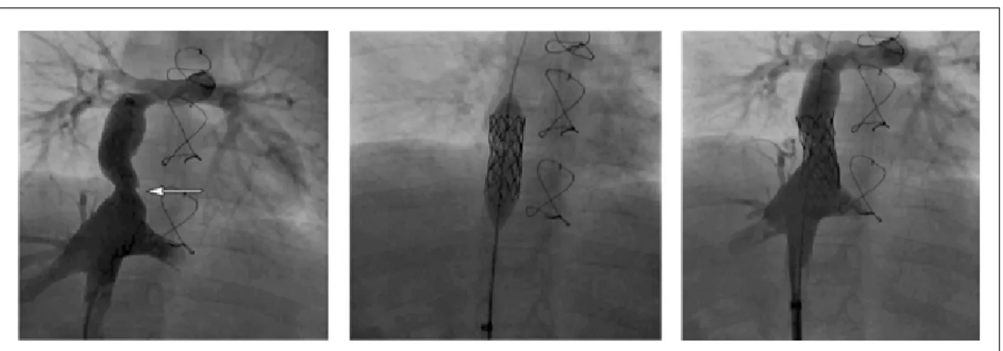 Figure 2 - Angiographic aspects pre A1: diffuse stenosis on ECC (arrows), A2: collateral veins (arrow); A3: balloon inlated with limit rupture pressure, keeping stenosis  on the tube (arrow), A4: inal aspect