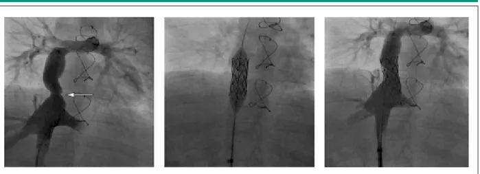 Fig.  2  - Aspectos angiográicos pre A1: estenosis difusa en el TEC (lechas); A2: colaterales venosas (lechas); A3: balón insulado con presión límite de rotura,  manteniendo estenosis en el tubo (lecha); A4: aspecto inal