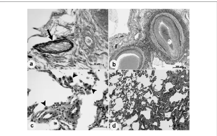 Figure 1 -  Photomicrographies of the lung biopsy showing in: A) a venule with ibrotic luminal occlusion (arrow); B) severe intimal proliferative lesions in pre-acinar arteries; 