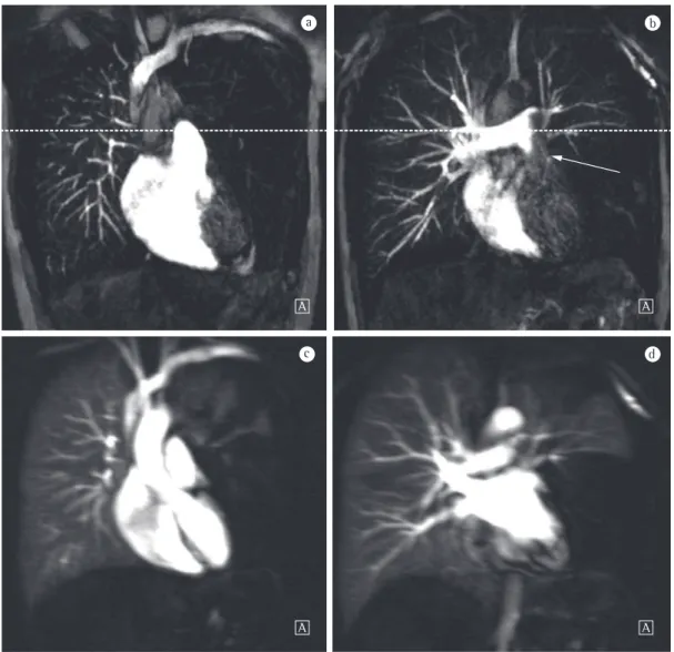 Figura 6 - Em A e B, angiografia por ressonância magnética coronal de alta resolução espacial com contraste  mostrando uma área avascular no pulmão esquerdo (A) e falha de enchimento na artéria pulmonar esquerda  (B, seta)
