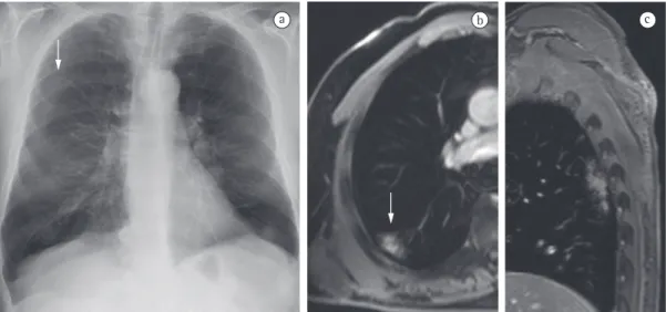 Figura 8 - Em A, radiografia de tórax mostrando uma opacidade suspeita no pulmão direito (seta)