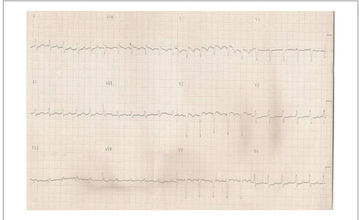 Fig. 1 -  ECG. Taquicardia atrial 2:1; baixa voltagem dos complexos QRS no plano frontal; distúrbio da condução intraventricular do estímulo 