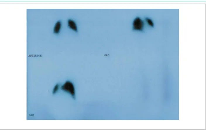 Fig. 3 -  Cintilograia. Aumento da área cardíaca, discretas alterações da distribuição do traçcador em segmentos anterior e laterais basais do lobo inferior direito