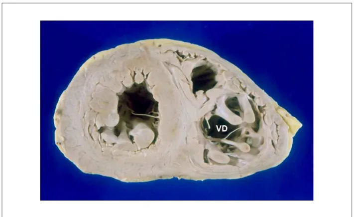 Fig. 6 -  Corte transversal dos ventrículos mostrando hipertroia e dilatação de ambos as câmaras, mais proeminente à direita (VD).