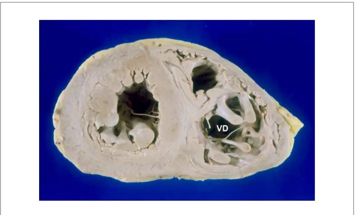 Figure 6 -  Cross section showing ventricular hypertrophy and dilatation of both chambers, most prominent on the right (RV).