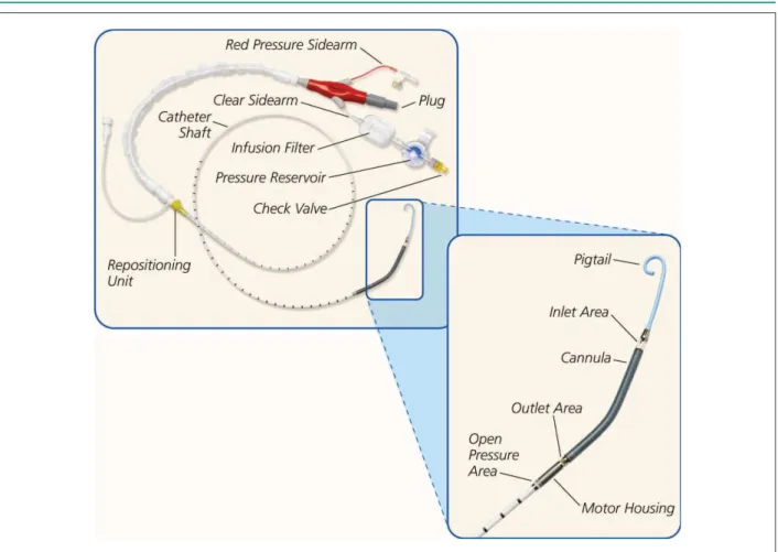 Figure 1 –  Illustration of Impella  ®  device, showing the 12F catheter with inlow in the left ventricle and outlow in the ascending aorta.