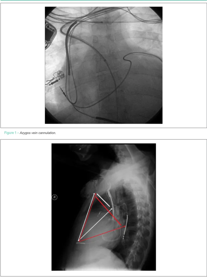 Figure 2 –  Chest x-ray in proile (red arrows show a greater amount of “ventricular mass” with the electrode placed in the azygos vein,  compared with the conventional lead position).