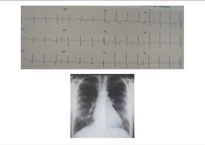 Fig. 1 -  Radiograia de tórax salienta área cardíaca normal, arco médio retiicado e trama vascular pulmonar algo aumentada nos hilos pulmonares