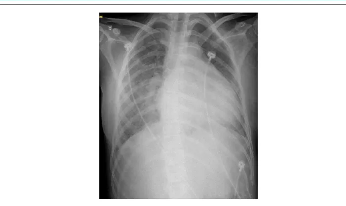 Figure 1 -  Chest radiography with cephalization of vascular weft, perihilar venous congestion, presence of lung parenchyma with diffuse interstitial edema and moderate  increase in heart size.