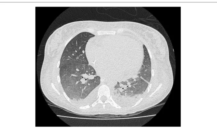 Figure 2 -  Computed tomography of the chest showed bronchocentric opacities, small areas of pulmonary consolidation, pleural effusion and extensive bilateral  homogeneous frosted glass.
