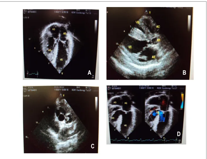 Fig. 2 –  Ecocardiograma mostra hipertroia acentuada de ventrículo direito com cavidade diminuída em corte de 4 câmaras em A,  estenose pulmonar subvalvar e anular  em conexão com o ventrículo esquerdo em corte longitudinal em B, aorta anterior e maior que