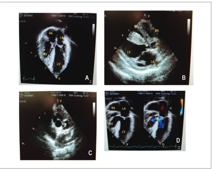 Figure 1 -  Chest X-ray reveals normal cardiac area with rounded morphology, excavated middle arch and pulmonary vasculature increased in the pulmonary hila