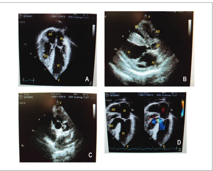 Figura 1 –  Radiografía de tórax destaca área cardíaca normal con morfología redondeada, arco medio escavado y trama vascular pulmonar aumentada en los hilos  pulmonares