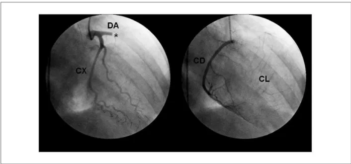Figure 2 –  Coronary angiography showing proximal thrombotic occlusion of the anterior descending artery and presence of inter and intracoronary collateral circulation