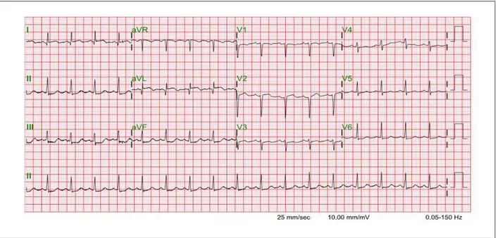 Figura 1 -  Electrocardiograma de 12 derivaciones en reposo que demuestra taquicardia sinusal, zona eléctricamente inactiva en la pared ántero-septal, supradesnivelación  del segmento ST en la parede lateral alta (DI y aVL), e infradesnivelación del segmen