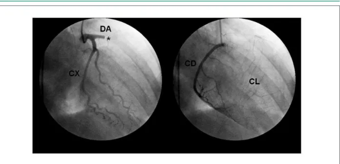 Figura 2 –  Coronariografía demostrando la oclusión trombótica proximal de la arteria descendente anterior y la presencia de circulación colateral inter e intracoronaria