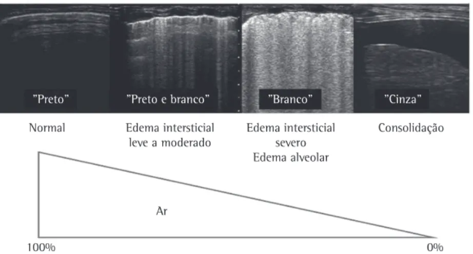 Figura 1 - Princípios físicos do ultrassom pulmonar. Quanto menos aerado o pulmão, mais fácil é a detecção 