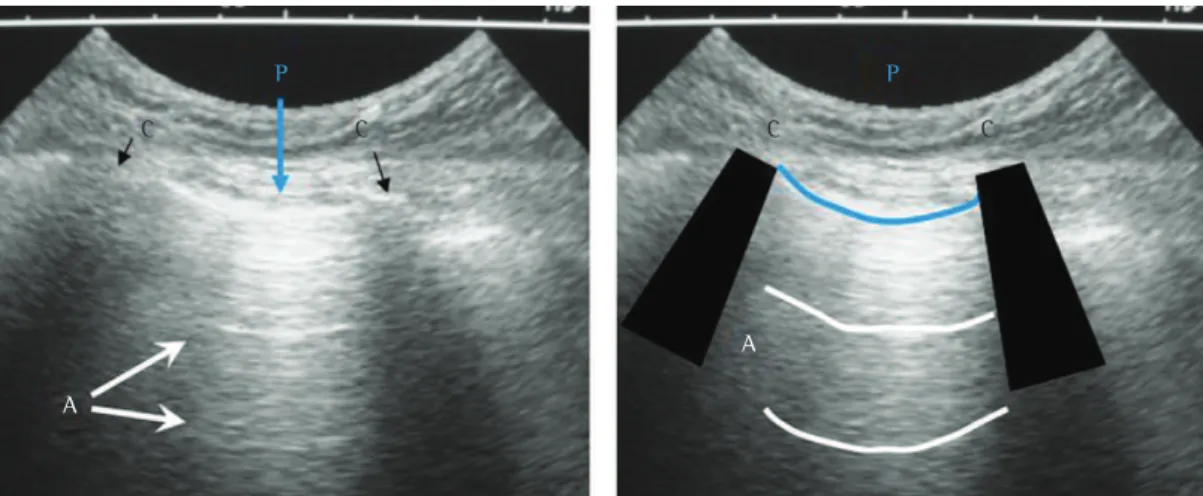 Figura 3 - Imagens de ultrassom pulmonar em pulmão normal. À esquerda, é identificado um espaço intercostal, 
