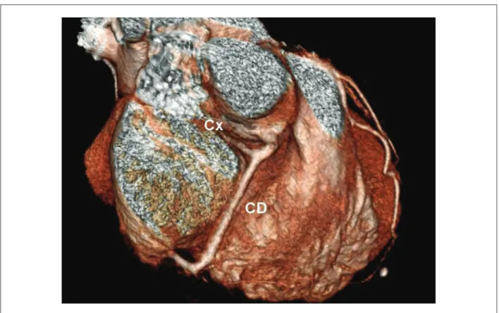 Figura 3 –  Angiotomografía coronaria multislice demostrando arteria circunleja originándose de la coronaria derecha