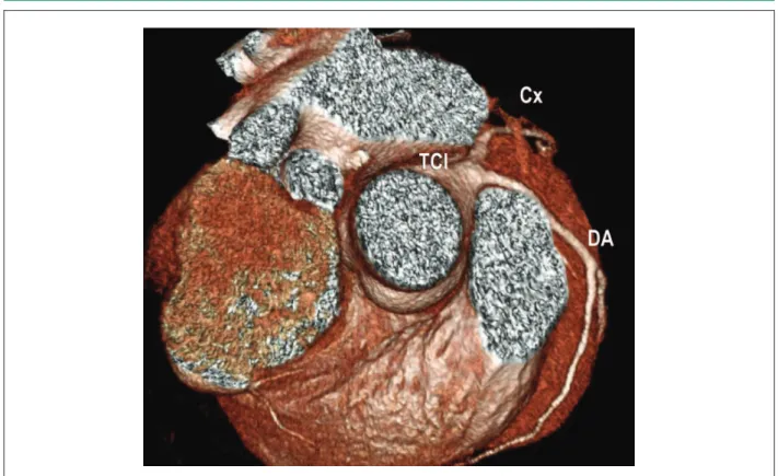 Figura 4 –  Angiotomografía coronaria multislice tronco coronario único. Cx - Arteria circunleja; TCI - Tronco coronario izquierdo; DA - Descendente anterior.