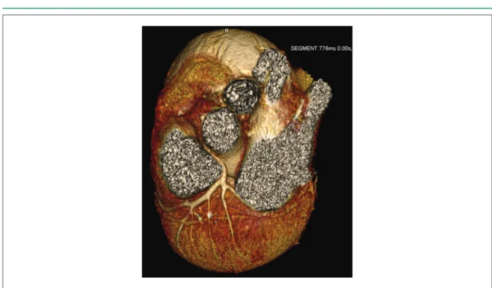 Figura 6 –  Angiotomografía coronaria multislice demostrando trayecto anómalo del tronco coronario izquierdo.