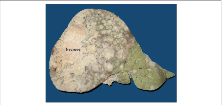 Figure 3 –  Macroscopic section of the liver showing large necrotic neoplastic mass in the right lobe and multiple smaller neoplastic nodules.