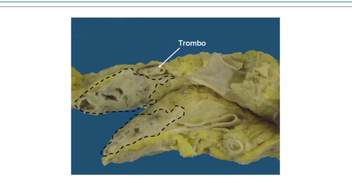 Figure 4 –  Macroscopic section of the pancreas tail with an area of the parenchyma replaced by tumor