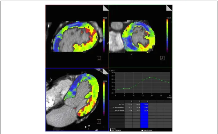 Figure 1 -  Quantitative analysis of dynamic perfusion. Notice in blue, the areas showing myocardial perfusion deicit and in green, normal myocardial areas