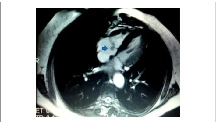 Figure 2 -  Magnetic Resonance: sessile mass in the atrial face of the tricuspid valve septal lealet (arrow).