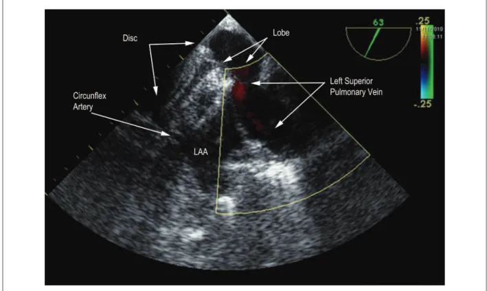 Figure 5 –  Transesophageal Echocardiography (63º): Implanted device. Note the preservation of surrounding structures