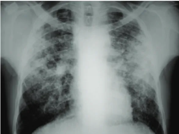 Figura 3 - Radiografia de tórax de paciente com 