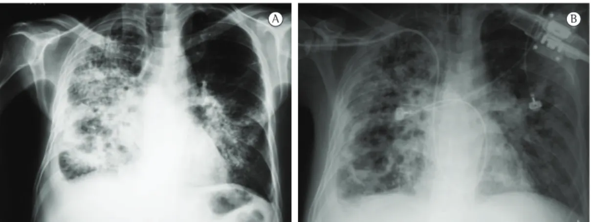 Figura 4 - Radiografias de tórax de paciente com tuberculose com evolução para SARA, com intervalo de 