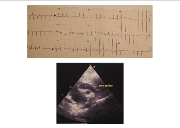 Figure 1 -  Electrocardiogram highlights signs of marked right ventricular overload in the preoperative period and the echocardiogram shows a clear obstruction  in the isthmic region.
