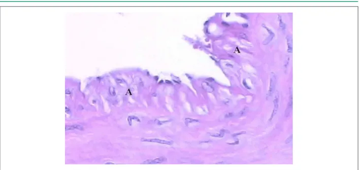 Figura 1 –  Sección transversal microscópica de la rama interventricular paraconal de la arteria coronaria izquierda, enrojecida por el método hematoxilina-eosina,  presentando espesamientos en toda la extensión de la capa íntima, donde se observaron célul