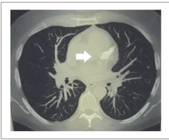 Fig. 1 –  Tomograia de tórax revelou área cardíaca e trama vascular pulmonar  normais