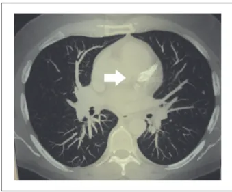 Fig.  1  –   Chest  tomography  showing  normal  cardiac  silhouette  and  pulmonary  vasculature