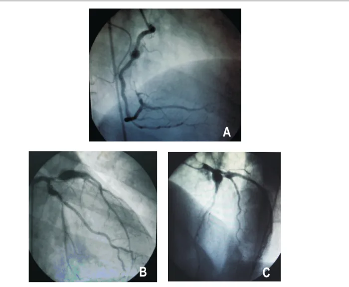 Fig. 2 –   Coronary angiography disclosed giant aneurysms in early-thirds of the anterior interventricular, circumflex and right coronary arteries (A, B and C)