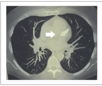 Figura 1 –  Tomografía de tórax reveló área cardíaca y trama vascular pulmonar  normales
