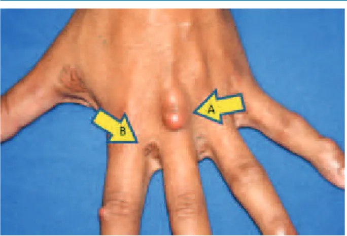 Fig. 2 - Xantoma tendionoso (A) em região dorsal da mão e xantomas planares  intertriginosos (B) em portador de HF homozigótica.