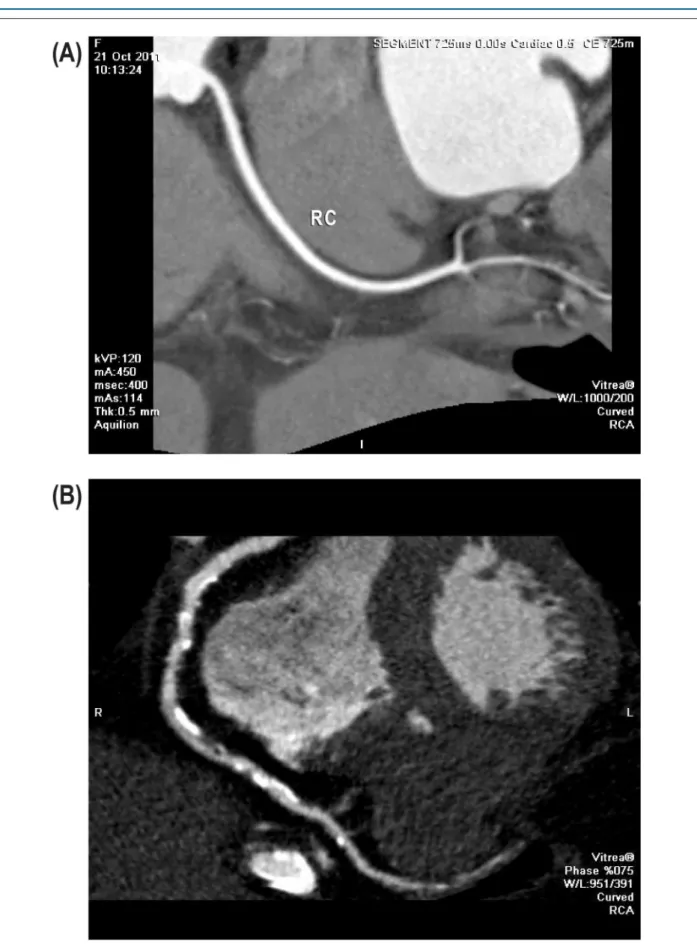 Figure 1 – Coronary CT with multiplanar reconstruction showing normal right coronary artery (A) and artery with extensive atheromatous plaques (B) RC: 