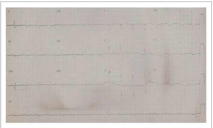 Fig. 1 - ECG. Ritmo sinusal, sobrecarga de câmaras esquerdas; área eletricamente inativa,da parede inferior e alterações da repolarização ventricular.