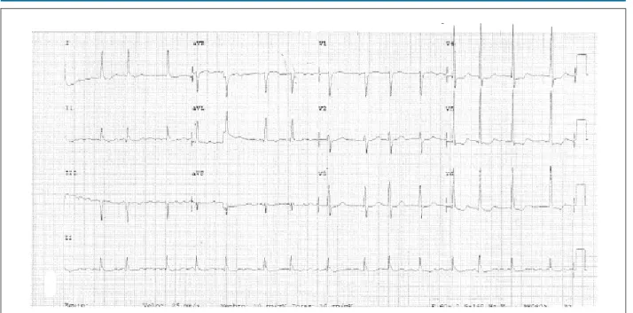 Fig. 3 – ECG: ibrilação atrial e sobrecarga ventricular esquerda