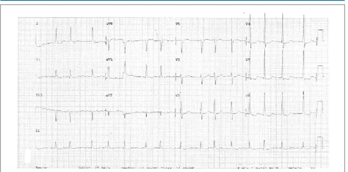 Figure 3 – ECG: atrial ibrillation and left ventricular overload