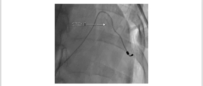 Fig. 2 – Stent de sustentação de Eletrodo de SC; FONTE: Paciente 2.