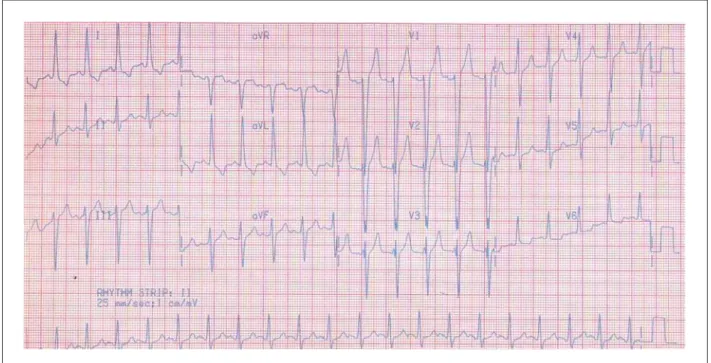 Fig. 1 – ECG. Ritmo sinusal, sobrecarga ventricular esquerda. 