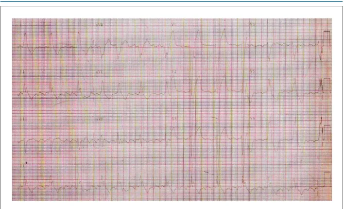 Fig. 2 – ECG. Fibrilação atrial, bloqueio de ramo esquerdo. 