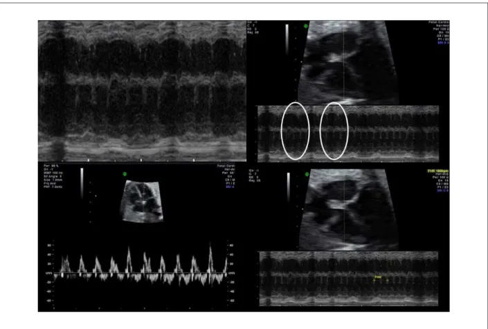 Fig. 1 – A e B: Dissociação Av com taquicardia ventricular moderada em modo M; C: ausência intermitente de onda de contração atrial; D: taquicardia ventricular a 188  bpm em modo M.
