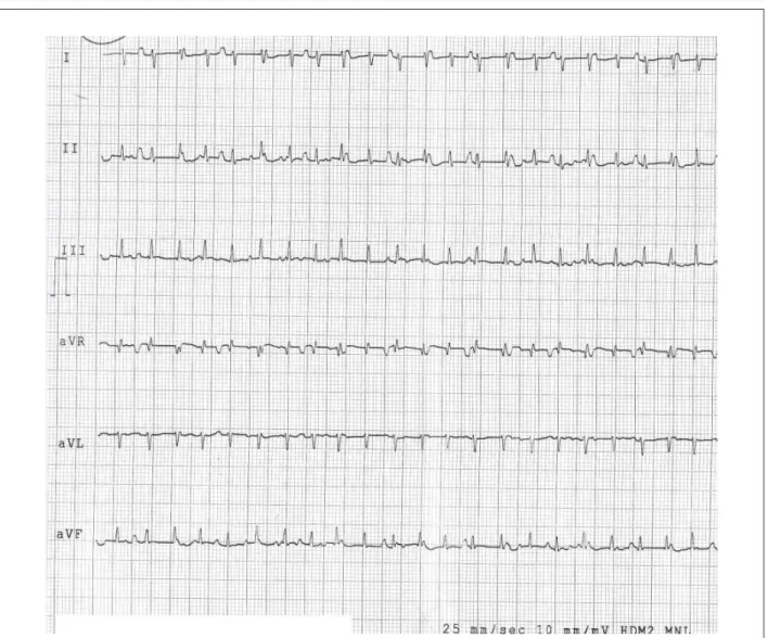 Fig. 2 – ECG neonatal mostrando taquicardia regular com QRS estreito, com dissociação AV.