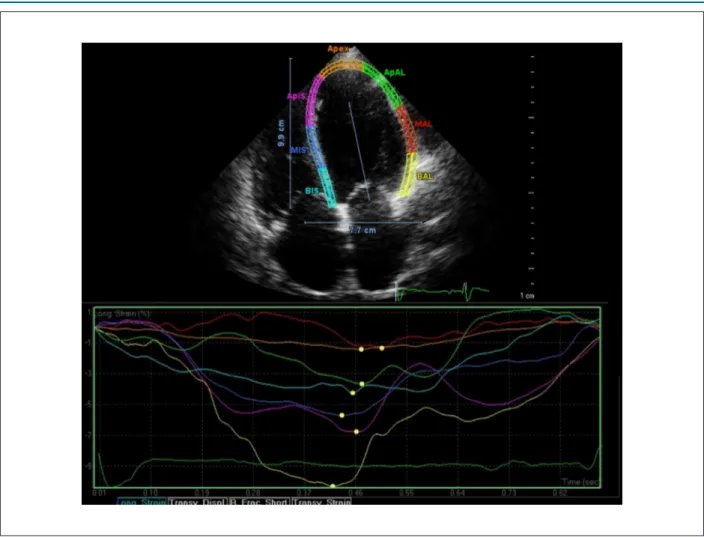 Figure 2 – Longitudinal myocardial deformation in a patient from DCM group. Observe the decrease in global longitudinal transmural strain (GS = -4.4%)