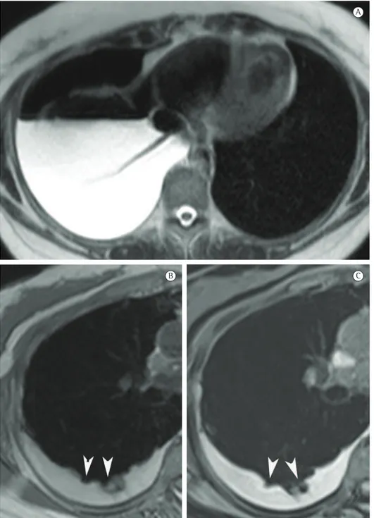 Figura 2 - Imagens de ressonância magnética (RM). Em A, sequência axial em T2 do terço inferior do 